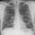Symptoms of Lung Cancer