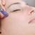 4 Amazing Benefits of Microneedling - 