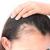 Common Side Effects of Minoxidil