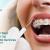 Transform your Smile with Top Orthodontic Services in Sarjapur Road