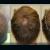 PRP Hair Transplant in Tirupati | Hair Loss Treatment in Tirupati