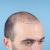 Is Hair Transplant Painful? (In Hindi)