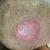 Best Scalp Infections Treatment in Bangalore - Dr. Health Hair Clinic