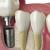 Dental Implants Market Share. Analysis of Top Companies/ Surgeons (AG, Bicon Dental Implants, Anthogyr, KYOCERA Medical, Lifecore and more) Set to Rise more than 6% CAGR by 2025 - openPR