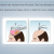 Synthetic or Artificial Hair Transplant Delhi, India: Nido &amp; Biofibre implant