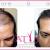 Artificial hair transplant and replacement procedure cost in India