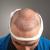 The Real Cost of a Hair Transplant in India