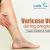 Varicose Veins In Pregnancy - Causes, Symptoms &amp; Treatments