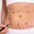 Tummy Tuck Cosmetic Surgery 