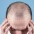 Hair Transplant in Delhi | Hair Replacement - Monaris