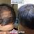 #1 Best LLLT Treatment for Hairfall in Durgapur