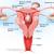 Uterine Fibroids - Herbal Remedies and Ayurvedic Treatment