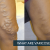 Varicose Veins Laser Treatment in Hyderabad | Varicose Veins