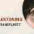 What is Cobblestoning in Hair Transplant ?
