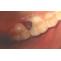 LASER ASSISTED EXCISION OF A GINGIVAL POLYP
