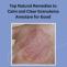 Top Natural Remedies to Calm and Clear Granuloma Annulare for Good