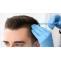 What you need to know about FUE Hair Transplant Procedure