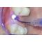 How do implant doctors use dental laser effectively？