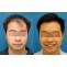 Per Graft Cost of Hair Transplant Dubai - hairtransplantdubaiae’s diary