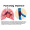 How is pulmonary embolism diagnosed Article - ArticleTed -  News and Articles