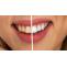 Comparison of Laser Teeth Whitening and LED cold light bleaching