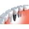 Dental Implants Adelaide