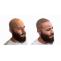 6 Reasons to Consider Scalp Micropigmentation 
