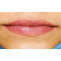 Lip Depigmentation with Laser