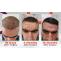 FUE Hair Transplant in Peshawar Cost 