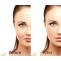 Anti Aging Treatment in Delhi | Anti Ageing Treatment | Anti Aging Skin Treatment