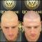 Scalp Micropigmentation Melbourne | SMP Clinic | Hair Tattoo Treatment
