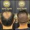 Scalp Micropigmentation Melbourne | SMP Clinic | Hair Tattoo Treatment