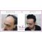 Hair Transplant at Satya Hair Clinic by Trained Surgeons