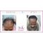 FUT Treatment in Delhi or Follicular unit Transplant by Satya Hair Clinic