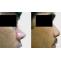 Rhinoplasty Mumbai - Latransformatione