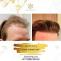 Hair Transplant Clinic in Dubai &amp; Abu Dhabi | Most Advanced FUE Specialist