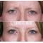 Botox Treatment to Minimize Wrinkle and Lines