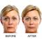 Botox Treatment | Botox Treatment Clinic Delhi | Botox Wrinkles Treatment