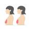 Best Breast Augmentation in Delhi, Breast Implant in Delhi