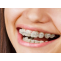 Treatment for Ceramic Braces in India | Healing Touristry