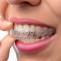 Clear Aligners in Dombivli | Invisalign Aligners Treatment