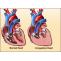 Pediatric Congestive Heart Failure Treatment in India