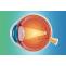 Cornea Specialist In Gurgaon | Cornea Diseases Treatment
