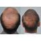  Crown Hair Transplant AT Hair Transplant Dubai Clinic - Best Hair Transplantation Dubai 