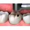  Treatment for Dental Inlays and Onlays in India- Healing Touristry