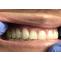 Dental Bridge Near Me | Cantilever Bridge Dental – Urbn Dental Midtown