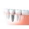  Dental Implants Procedure Treatment in India - Healing Touristry
