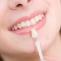 Dental Veneers Canberra | Molonglo Dental Surgery 