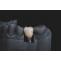 dental implants san antonio
