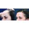  Different Types of Hair Loss in Females - Best Hair Transplantation Dubai 